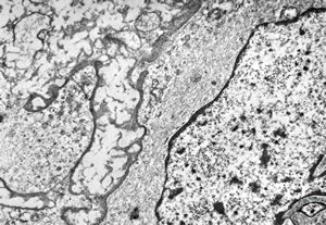 F,22y. | Pindborg tumor F,22y. | Pindborg tumor